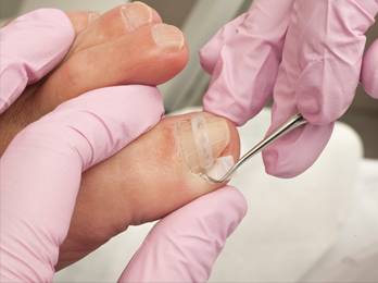 Ingrown Toenails Treatment in the Broward County, FL: Tamarac (Margate, Coral Springs, Sunrise, Lauderdale Lakes, Wilton Manors, Coconut Creek, Lauderhill, Parkland, Oakland Park, Plantation, Pompano Beach) and Pembroke Pines (Miramar, Weston, Davie, Dania Beach, Hallandale Beach, Hollywood), and Miami-Dade County, FL: Miami Gardens, Opa-locka, Aventura, Hialeah, Country Club, Golden Glades areas