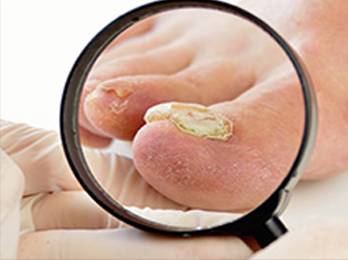 Fungal Toenail Treatment in the Broward County, FL: Tamarac (Margate, Coral Springs, Sunrise, Lauderdale Lakes, Wilton Manors, Coconut Creek, Lauderhill, Parkland, Oakland Park, Plantation, Pompano Beach) and Pembroke Pines (Miramar, Weston, Davie, Dania Beach, Hallandale Beach, Hollywood), and Miami-Dade County, FL: Miami Gardens, Opa-locka, Aventura, Hialeah, Country Club, Golden Glades areas