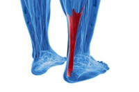 Facts About Achilles Tendonitis