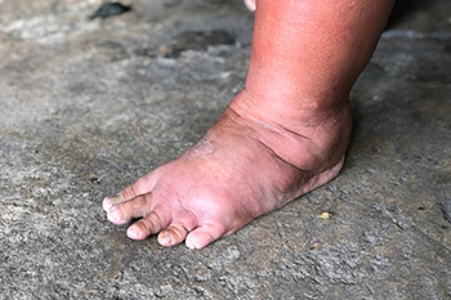Unraveling The Mystery Of Cankles And How To Deal With Them Unraveling The Mystery Of Cankles And How To Deal With Them